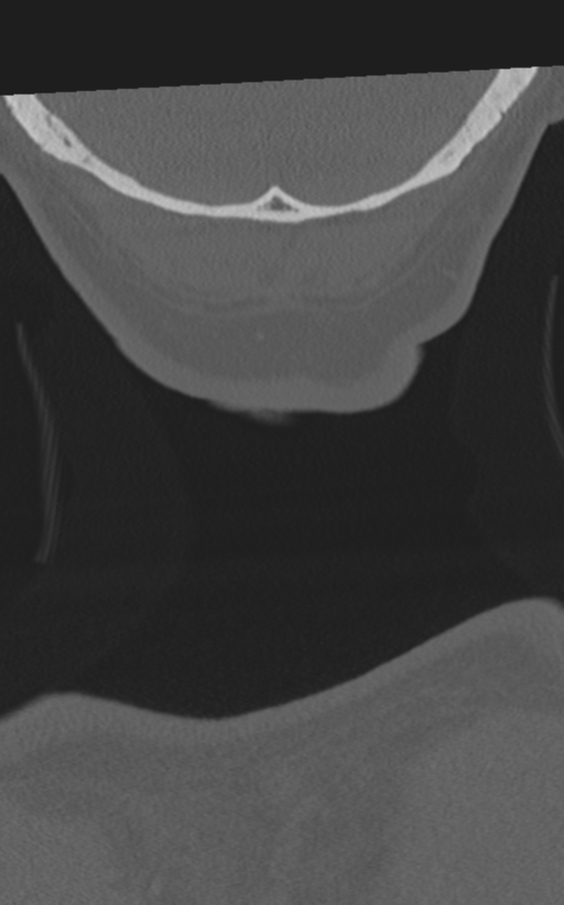 Cervical spine fractures with vertebral artery dissection (Radiopaedia 53296-59268 Coronal bone window 81).png