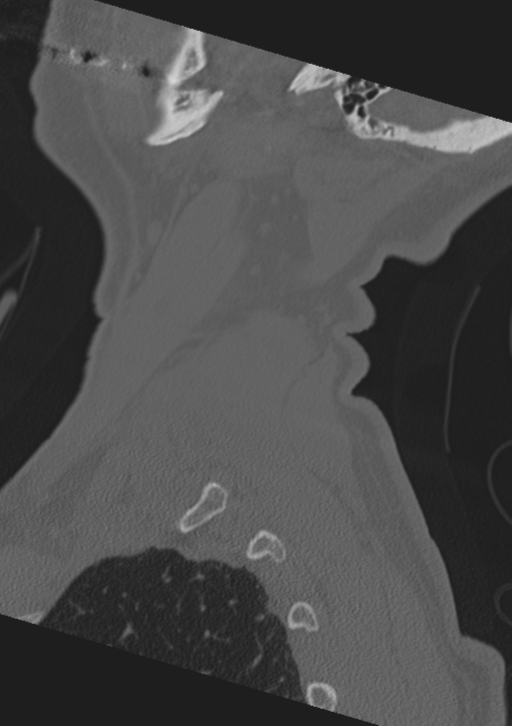 Cervical spine fractures with vertebral artery dissection (Radiopaedia 53296-59268 Sagittal bone window 66).png