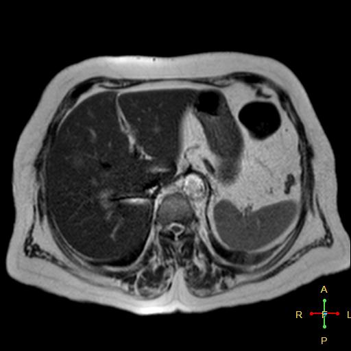 File:Cervical stump squamous cell carcinoma (Radiopaedia 48049-52858 I 12).jpg
