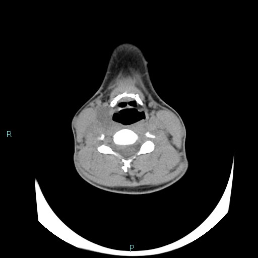 File:Cervical thymic cyst (Radiopaedia 88632-105335 Axial non-contrast 60).jpg