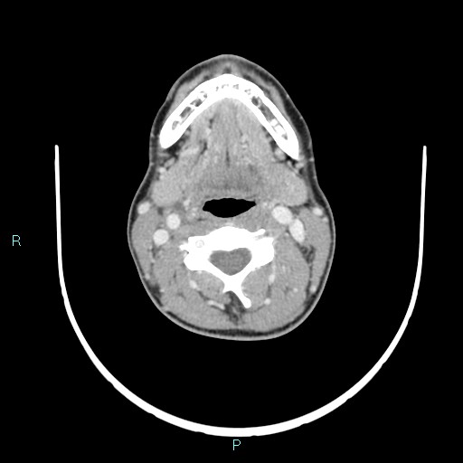 Cervical thymic cyst (Radiopaedia 88632-105335 C 71).jpg