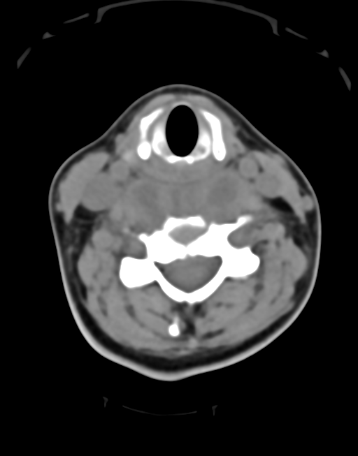 Cervical tuberculous spondylitis (Radiopaedia 39149-41365 Axial non-contrast 29).png