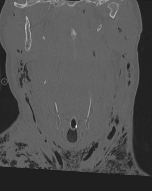 Chalk stick fracture (Radiopaedia 57948-64928 Coronal bone window 16).png