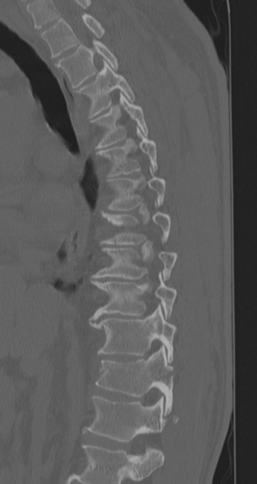 Chance fracture (Radiopaedia 33854-35020 Sagittal bone window 53).png