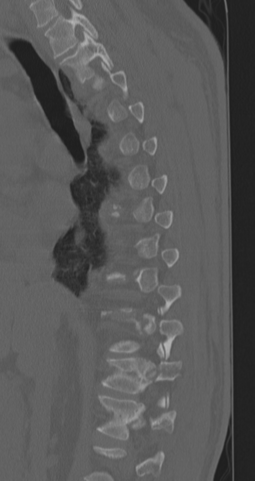 Chance fracture (Radiopaedia 33854-35020 Sagittal bone window 56).png