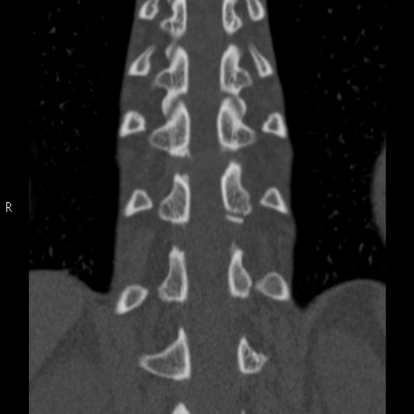 File:Chance fracture (Radiopaedia 36521-38081 Coronal bone window 43).jpg