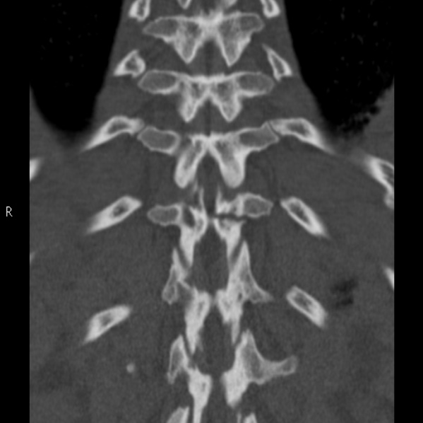 Chance fracture (Radiopaedia 36521-38081 Coronal bone window 48).jpg