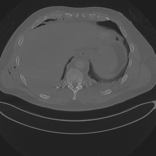 Chest multitrauma - aortic injury (Radiopaedia 34708-36147 Axial bone window 247).png