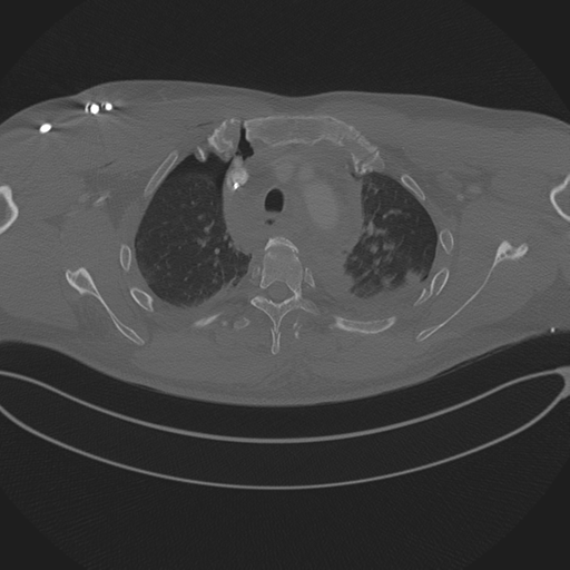 Chest multitrauma - aortic injury (Radiopaedia 34708-36147 Axial bone window 72).png