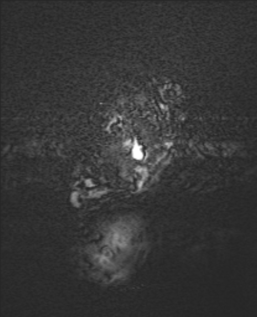 Chiari III malformation with occipital encephalocele (Radiopaedia 79446-92559 Axial SWI 2).jpg