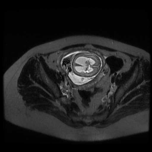 Chiari II malformation - fetal MRI (Radiopaedia 68099-77581 Axial T2-SSFSE 48).jpg