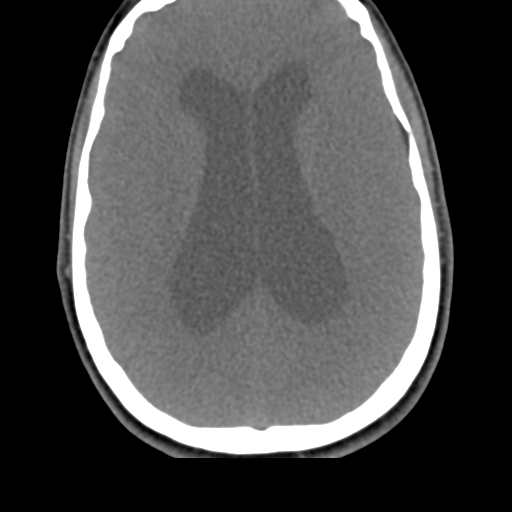 File:Chiari I malformation and obstructive hydrocephalus (Radiopaedia 41185-43981 D 5).png