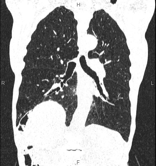 Chilaiditi sign (Radiopaedia 88839-105611 Coronal lung window 38).jpg