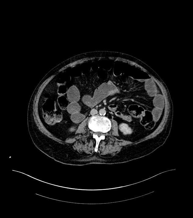 Cholangiocarcinoma with cerebral metastases (Radiopaedia 83519-98629 Axial C+ delayed 65).jpg