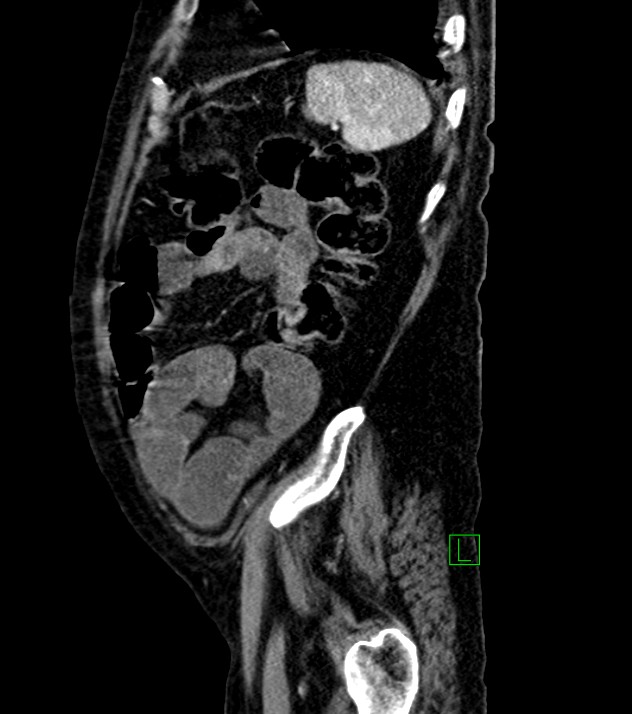 Cholangiocarcinoma with cerebral metastases (Radiopaedia 83519-98629 F 25).jpg