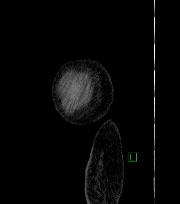 Cholangiocarcinoma with cerebral metastases (Radiopaedia 83519-98629 F 4).jpg