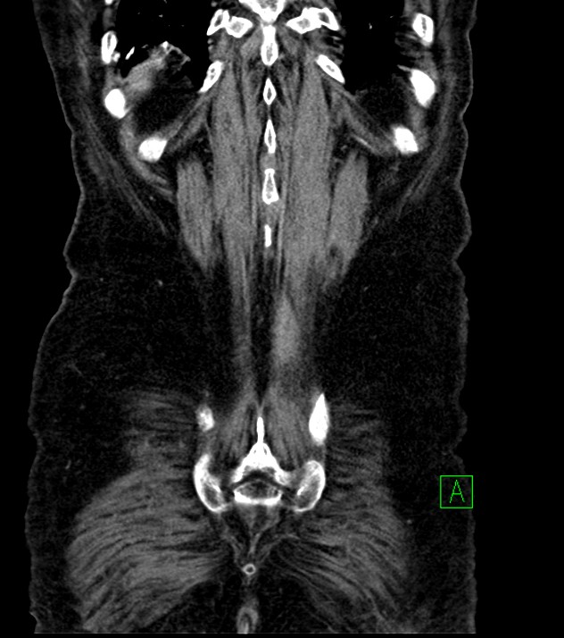 Cholangiocarcinoma with cerebral metastases (Radiopaedia 83519-98629 G 74).jpg