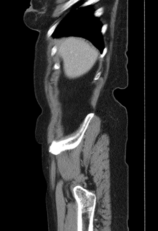Cholecystoduodenal fistula due to calculous cholecystitis with gallstone migration (Radiopaedia 86875-103077 F 54).jpg