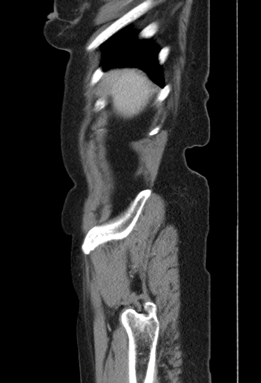 Cholecystoduodenal fistula due to calculous cholecystitis with gallstone migration (Radiopaedia 86875-103077 F 55).jpg
