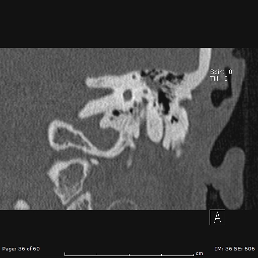 Cholesteatoma - external auditory canal (Radiopaedia 88452-105096 Coronal bone window 36).jpg