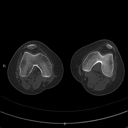 Chondroblastoma (Radiopaedia 62721-71030 Axial bone window 19).jpg