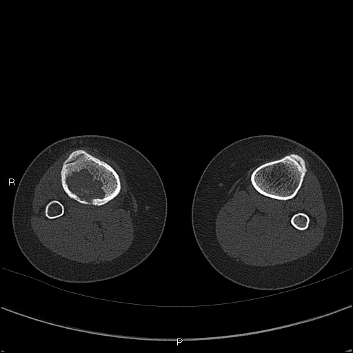Chondroblastoma (Radiopaedia 62721-71030 Axial bone window 88).jpg
