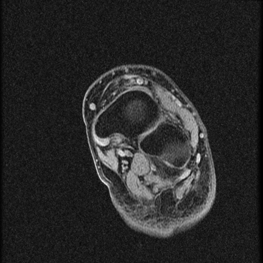 File:Chondroblastoma - midfoot (Radiopaedia 64831-73765 F 9).jpg
