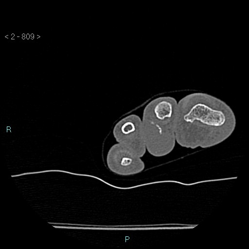 Chondrosarcoma - phalanx (Radiopaedia 69047-78812 Axial bone window 63).jpg