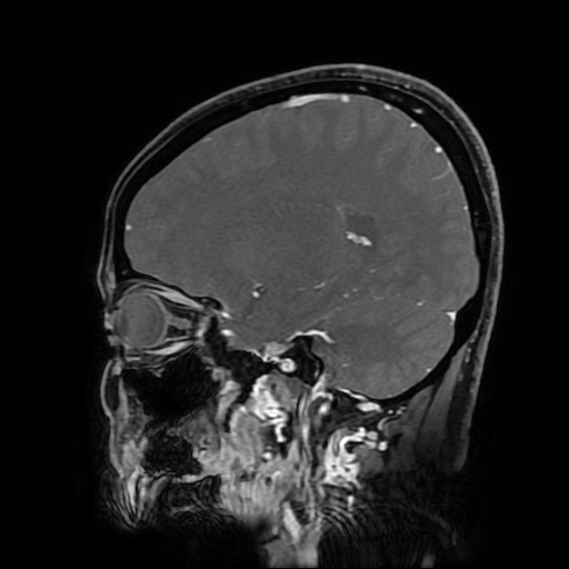 File:Chordoid glioma of third ventricle (Radiopaedia 91612-109340 F 136).jpg
