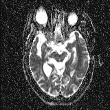 Choroid plexus xanthogranuloma - unilateral (Radiopaedia 85632-101393 Axial ADC 26).jpg