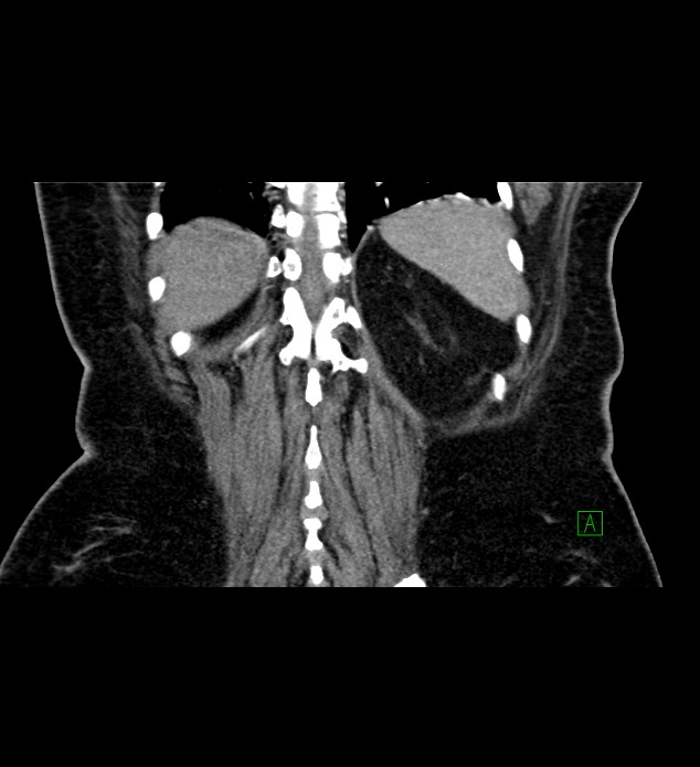 Chromophobe renal cell carcinoma (Radiopaedia 84239-99519 C 74).jpg
