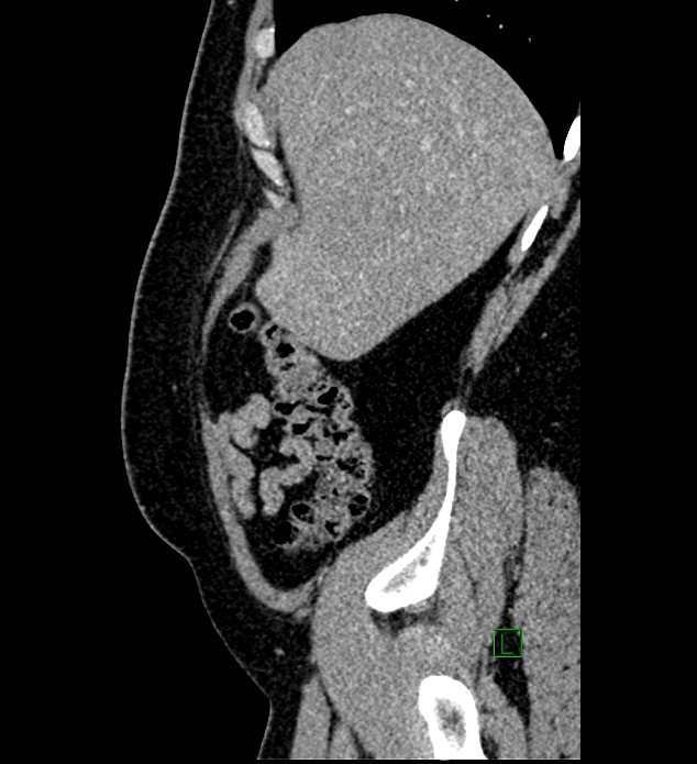 Chromophobe renal cell carcinoma (Radiopaedia 84286-99573 I 159).jpg