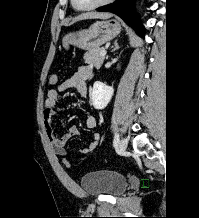 Chromophobe renal cell carcinoma (Radiopaedia 84286-99573 I 70).jpg
