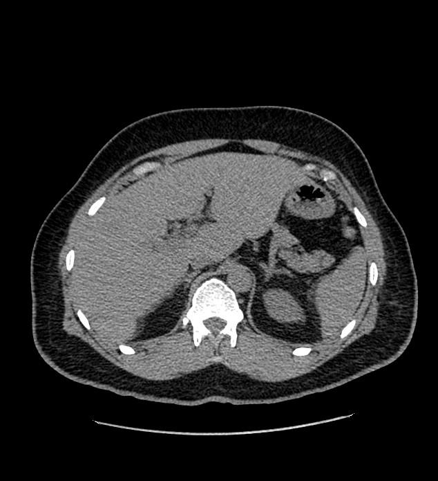 Chromophobe renal cell carcinoma (Radiopaedia 84337-99693 Axial non-contrast 30).jpg