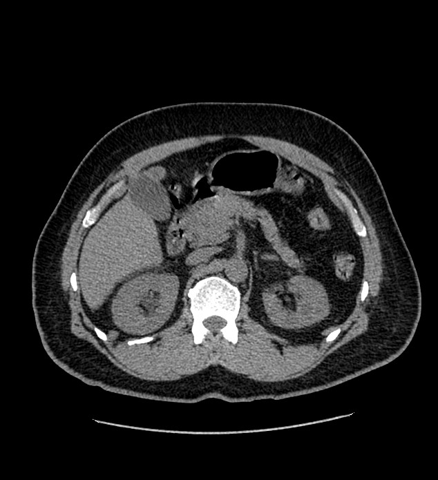 Chromophobe renal cell carcinoma (Radiopaedia 84337-99693 Axial non-contrast 44).jpg