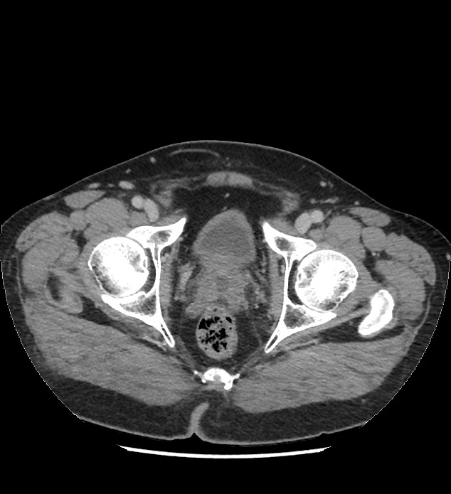 Chromophobe renal cell carcinoma (Radiopaedia 86879-103083 C 146).jpg