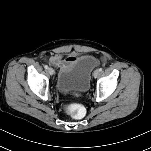 Chronic appendicitis complicated by appendicular abscess, pylephlebitis and liver abscess (Radiopaedia 54483-60700 B 129).jpg