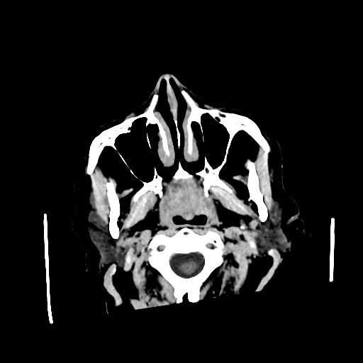 Chronic bilateral subdural hygroma (Radiopaedia 85801-101622 Axial non-contrast 16).jpg