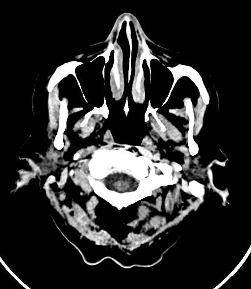 Chronic bilateral subdural hygroma (Radiopaedia 85801-101623 Axial non-contrast 58).jpg