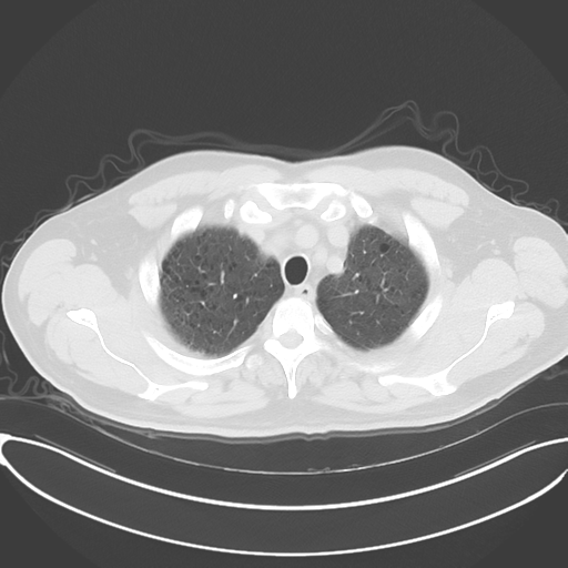 Chronic hypersensitivity pneumonitis (Radiopaedia 48107-52922 Axial lung window 14).png