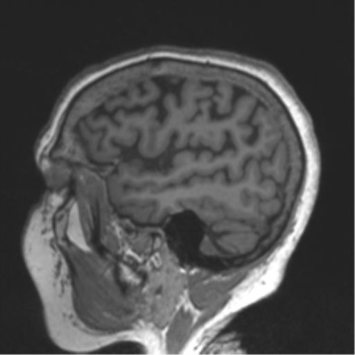 Chronic hypertensive encephalopathy (Radiopaedia 39993-42482 Sagittal T1 73).png