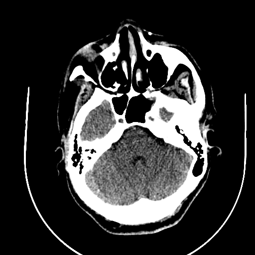 Chronic invasive fungal sinusitis (Radiopaedia 91563-109286 Axial non-contrast 21).jpg
