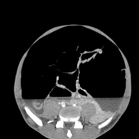 File:Chronic large bowel pseudo-obstruction (Radiopaedia 43181-46492 A 117).jpg