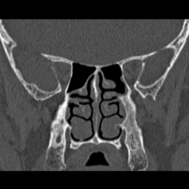 Chronic maxillary sinusitis (Radiopaedia 27879-28116 Coronal bone window 36).jpg