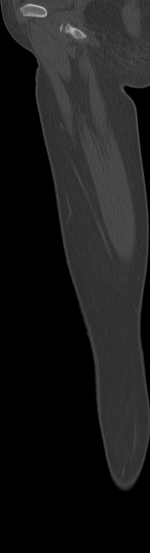Chronic ostemyelitis of the femur with long sinus tract (Radiopaedia 74947-85982 Sagittal bone window 82).jpg