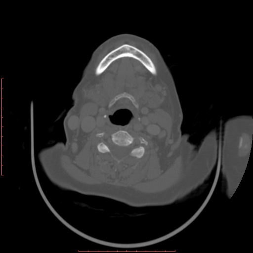 File:Chronic osteomyelitis - maxilla (Radiopaedia 23783-23927 Axial bone window 11).jpg