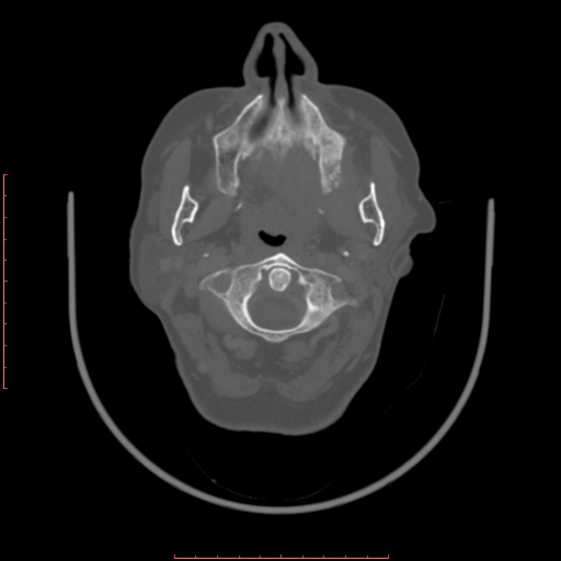 Chronic osteomyelitis - maxilla (Radiopaedia 23783-23927 Axial bone window 85).jpg