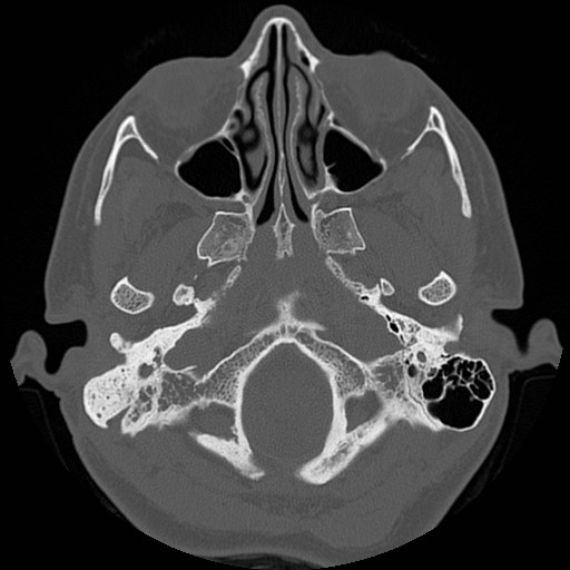 File:Chronic otomastoiditis (Radiopaedia 27138-27309 Axial bone window 8).jpg