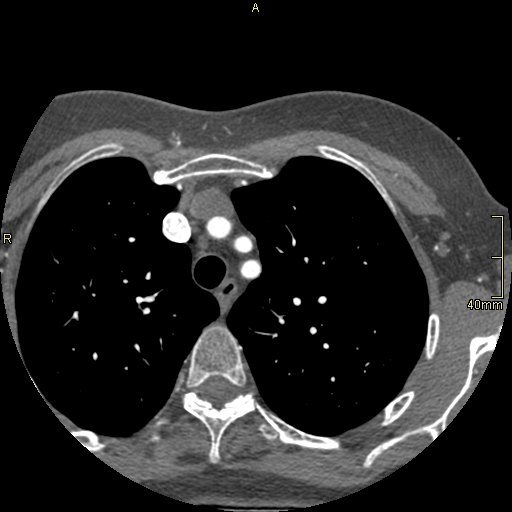 Chronic pulmonary embolism (Radiopaedia 73073-85094 Axial C+ CTPA 2).jpg
