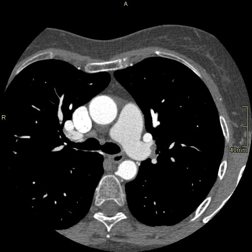 Chronic pulmonary embolism (Radiopaedia 73073-85094 Axial C+ CTPA 44).jpg